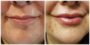 Lip fillers - before and after - Majestic Beauty Spa
