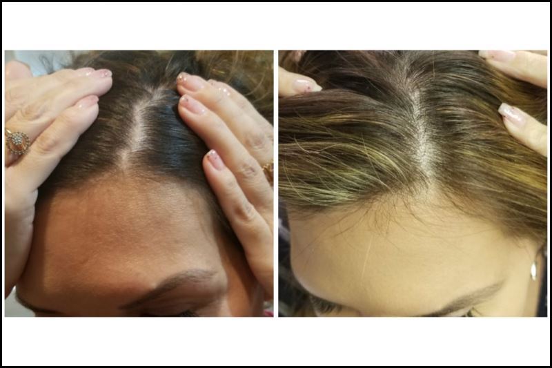 PRP Injection for Hair Loss