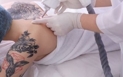 tattoo-removal-buckeye-az