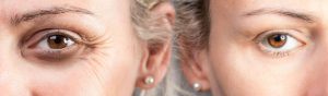 Botox Injections in Buckeye, AZ