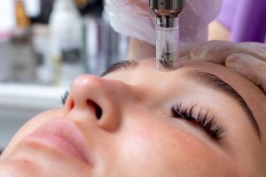 Microneedling Facials in Buckeye, AZ