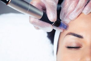 Microneedling with PRP in Buckeye, AZ