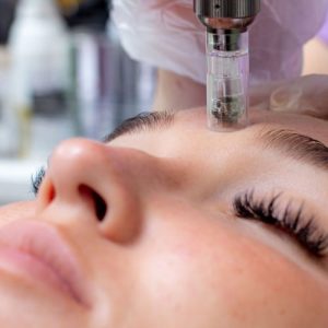 Microneedling in Buckeye, AZ