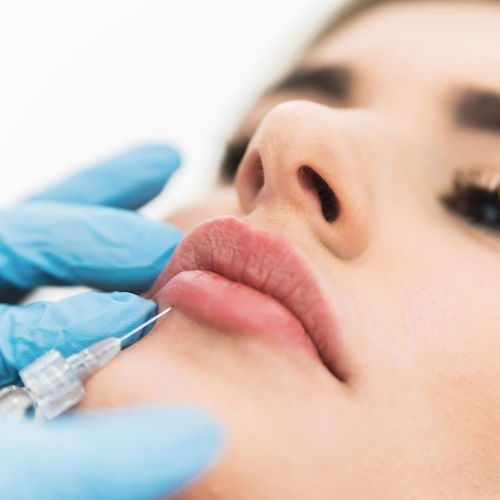 Lip Fillers in Buckeye, AZ