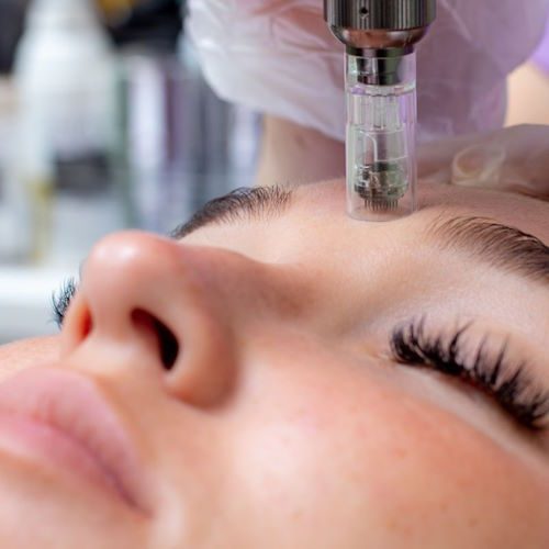 Microneedling in Buckeye, AZ