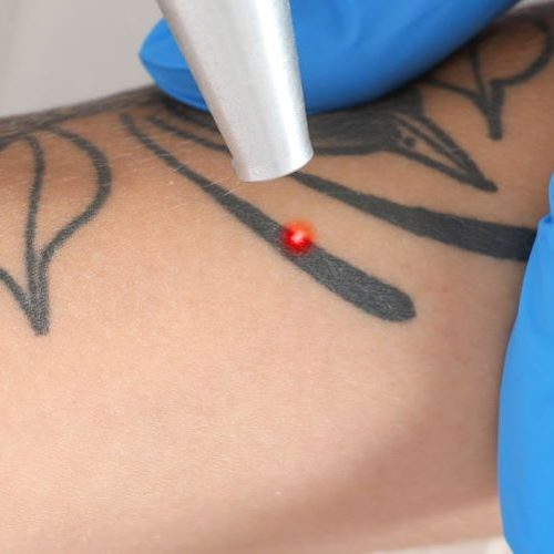 Tattoo Removal in Buckeye, AZ